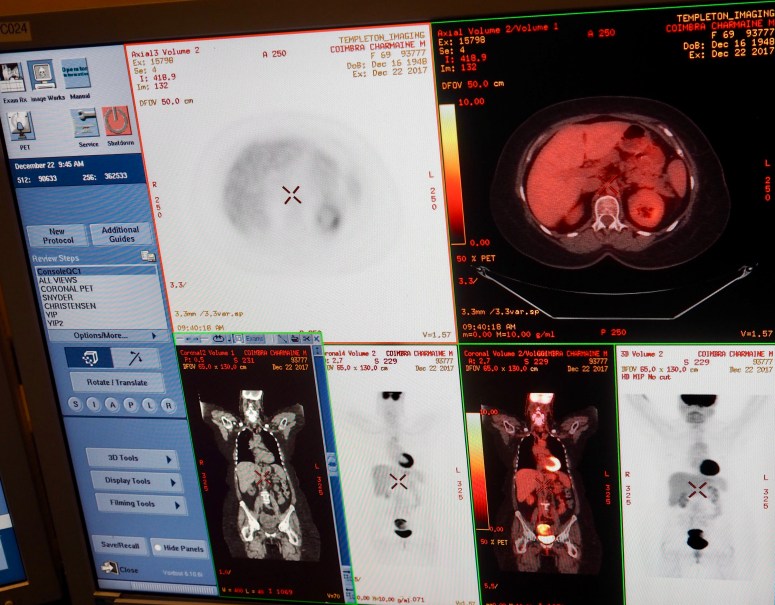 Results of my PET scan